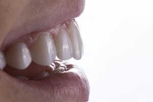 carillas estetica dental